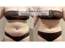 アイニティ ボディ トーニング 赤坂(INITY BODY TONING)の雰囲気（ハイパーナイフ・インディバ・吸引で大幅サイズダウンを実現！！）