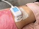 モンデュ(MonDue)の写真/最新脂肪冷却マシンで二の腕/お腹/太もも/お尻の脂肪を徹底撃退◎運動や筋トレが苦手な方にもおススメ