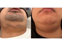 ワイスタイル(Ystyle)/20代男性　ヒゲ脱毛　１０回