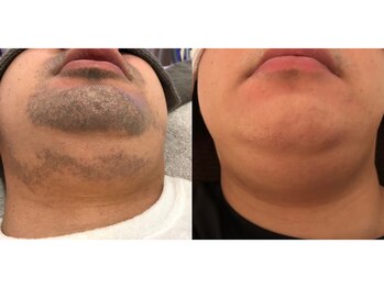 ワイスタイル(Ystyle)/20代男性　ヒゲ脱毛　１０回