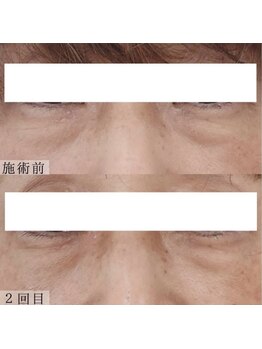 ヴェルシック(Belchic)/自力での改善は不可能な目の下