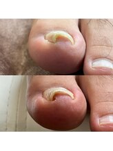 リリ(lili)/巻き爪矯正/4回目