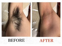 メンズブリリアンス/ワキ脱毛でムレもニオイもなし！