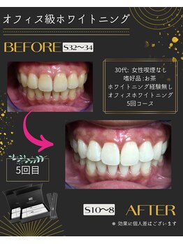 ホワイトニングプラス(Whitening+)/一度カウンセリングへ…