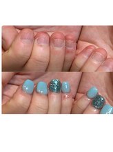 ティアラネイル 宇都宮/深爪矯正