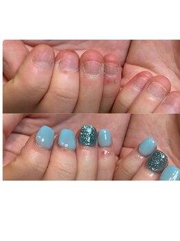 ティアラネイル 宇都宮/深爪矯正