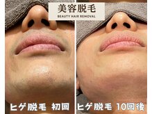 シエルエトワール 唐津店(Ciel Etoile)/美容脱毛　ヒゲ脱毛