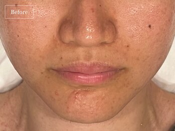 キュレイテッドスキン(CURATED SKIN)/ピーリング/毛穴ケア/肌質改善