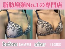 サラエクセレント 天王寺(SARA EXCELLENT)/デコルテのハリ感が復活！育乳