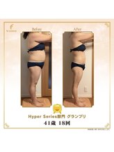 リンカ(Rinka.)/☆帯広初!!ハイパーナイフ導入☆