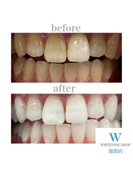 ホワイトニングショップ 池袋店/【ビフォーアフター】美白