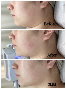 ルピア(L'pur)/小顔♪