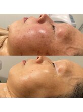 エステモ 札幌店(ESTEMO)/光フェイシャル★赤ら顔