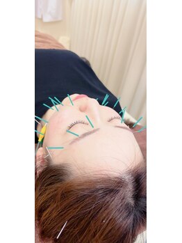 えにし整体 鍼灸整骨院/お顔のお悩みなら美容鍼灸☆