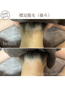 リリアーナ アサヒカワ(LILIANA ASAHIKAWA)/脱毛（襟足後ろ）