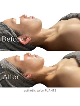 プランツ(PLANTS)/40代／１回／首凝りたるみ