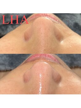 ヌン(NUN.)/ピーリング