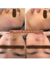 目が美きゅっと/人気NO1【エステ付き顔脱毛】