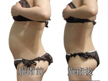 エリクシア 松戸/30代ウェスト痩身６回目