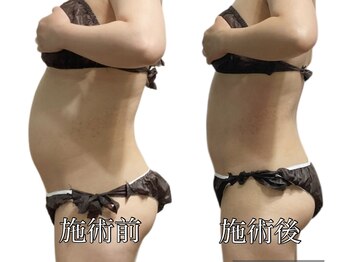 エリクシア 松戸/30代ウェスト痩身６回目