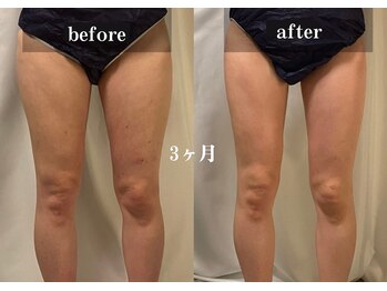 ダンデライオン 天神南店(dandelion)/痩身エステ2.5か月