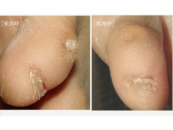 角質フットケアサロン リラックスパーク 大阪難波店(RelaxPark)/フットケア　魚の目　大阪