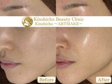 錦糸町ビューティークリニック/ララピール/毛穴/フェイシャル