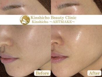錦糸町ビューティークリニック/ララピール/毛穴/フェイシャル