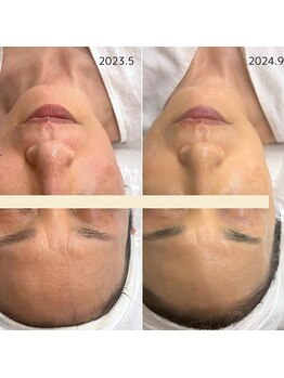 エルベ(ellbe)/リアボーテ幹細胞肌質改善