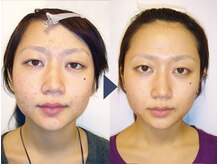 美デザイン 栄店(美.design)/☆小顔矯正+頭蓋骨矯正