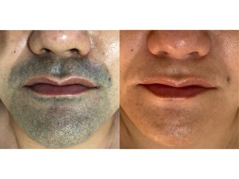 ワイスタイル(Ystyle)/40代男性髭脱毛　ヒゲ脱毛１５回