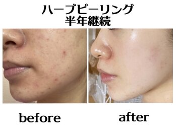 ハオン(HAON)/ハーブピーリング/ニキビ/毛穴