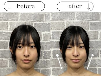 ビースタイル(B-style)/【電気美容鍼】ビフォーアフター