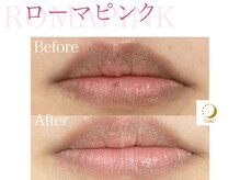 ツキ(TUKI+)/ローマピンク★全身の黒ずみ除去