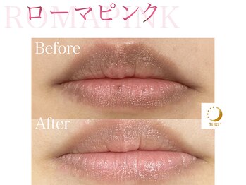 ツキ(TUKI+)/ローマピンク★全身の黒ずみ除去