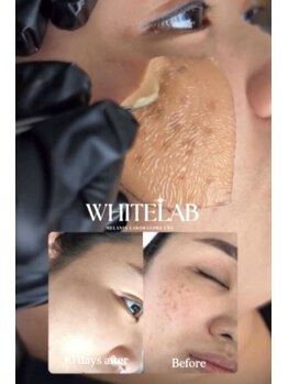 リリア(Lilia)/１回でポロっと最新シミケア