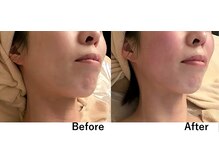 ビオモ 銀座(BIOMO)/V字フェイスライン＆首を長く！