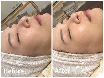 ラウレア(LAULEA)/ハーブピーリングbefore/after