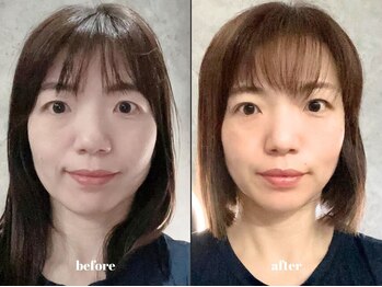福多整体院/◆小顔美肌×美容整体月一１年