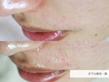 クリード(CLEAD)/フェイシャルワックス/8000円