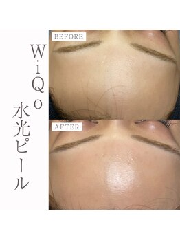 エイティスト(EiGHTiEST)/肌質改善