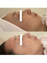 ナル(naru.)/羊膜幹細胞2回