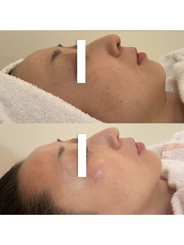 ナル(naru.)/羊膜幹細胞2回