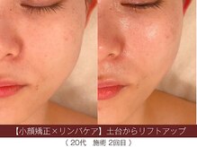 ホワイトカメリア(White Camellia)/【小顔矯正】持続するリフト