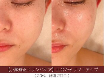 ホワイトカメリア(White Camellia)/【小顔矯正】持続するリフト