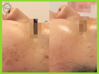 ハーブピーリング 名古屋/剥離なし　ハーブピーリング　1g