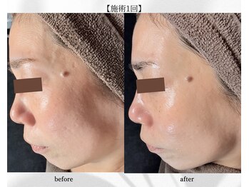 アン ビューティー(ann beauty)/施術1回【症例写真】