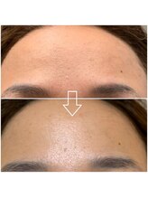 エラフリー/ビフォーアフター☆施術回数1回