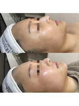 サーデ(saade)/乳酸菌ピーリング