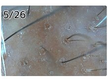 エルール トータルビューティ(Aileure total beauty)/育毛促進ケア　